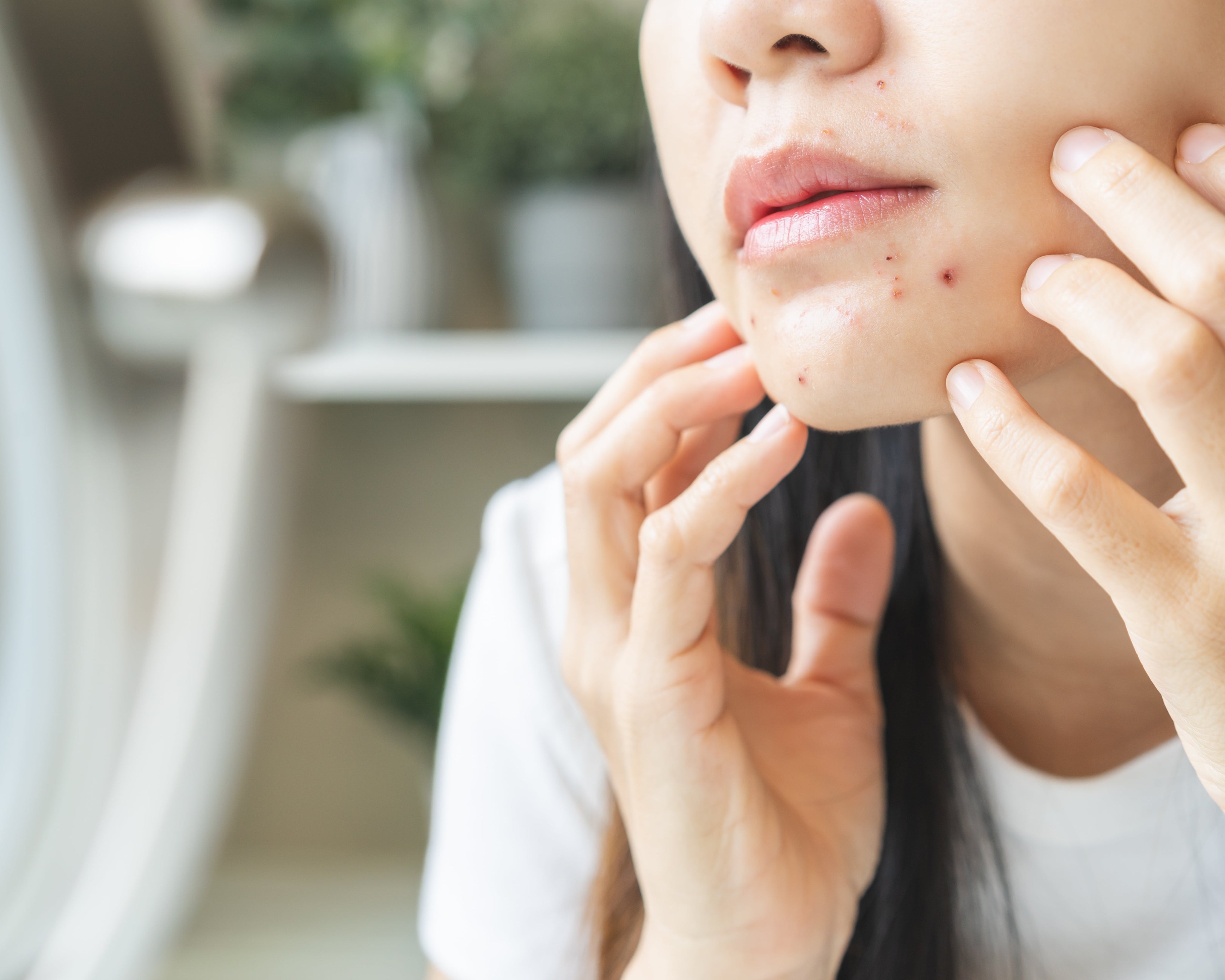 Comment la peau révèle les impacts du stress et de la santé mentale : une approche holistique