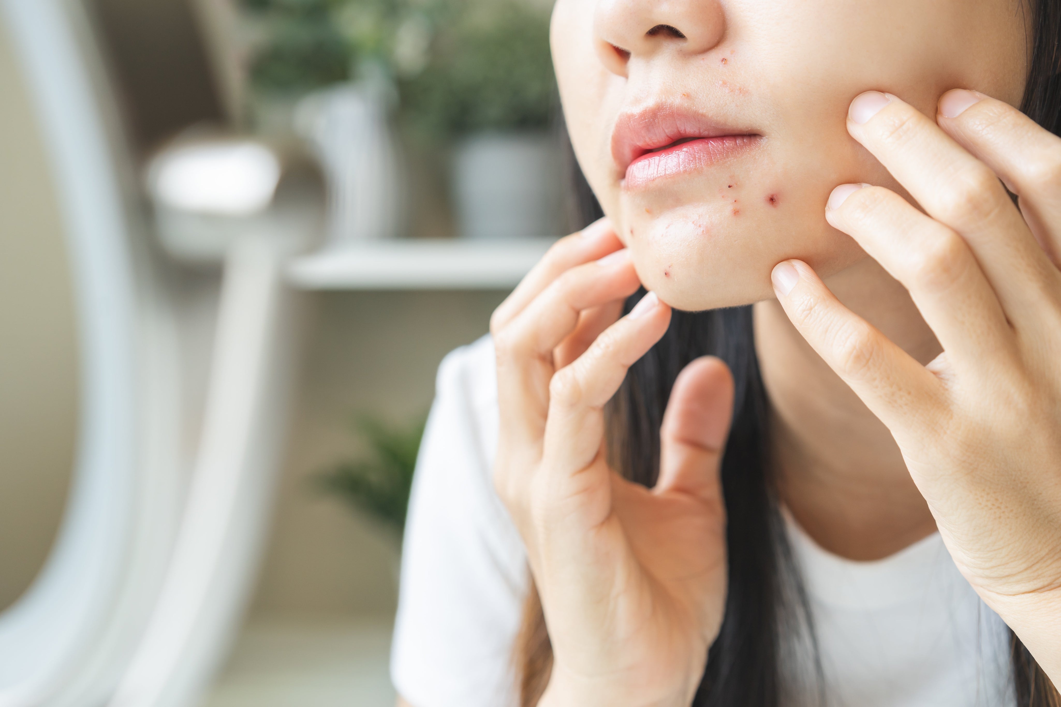 Comment la peau révèle les impacts du stress et de la santé mentale : une approche holistique